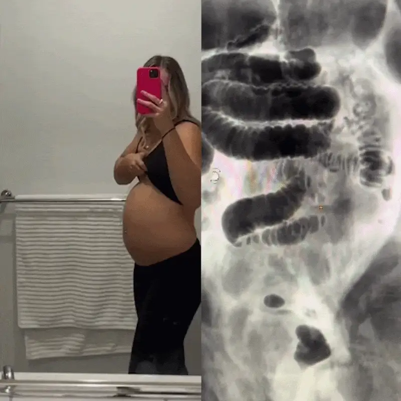Protocolo Intestino Livre
